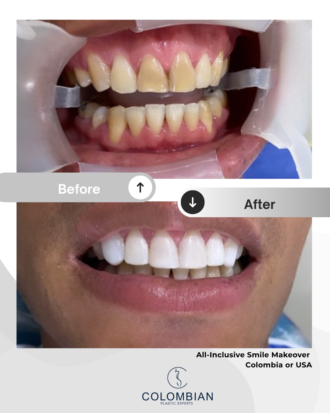 Full Payment – Smile Makeover Package (Cartagena, Colombia)