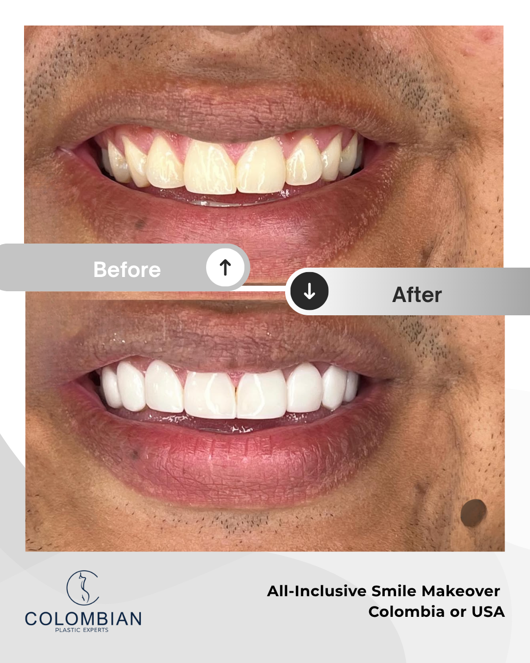 Full Payment – Smile Makeover Package (Cartagena, Colombia)