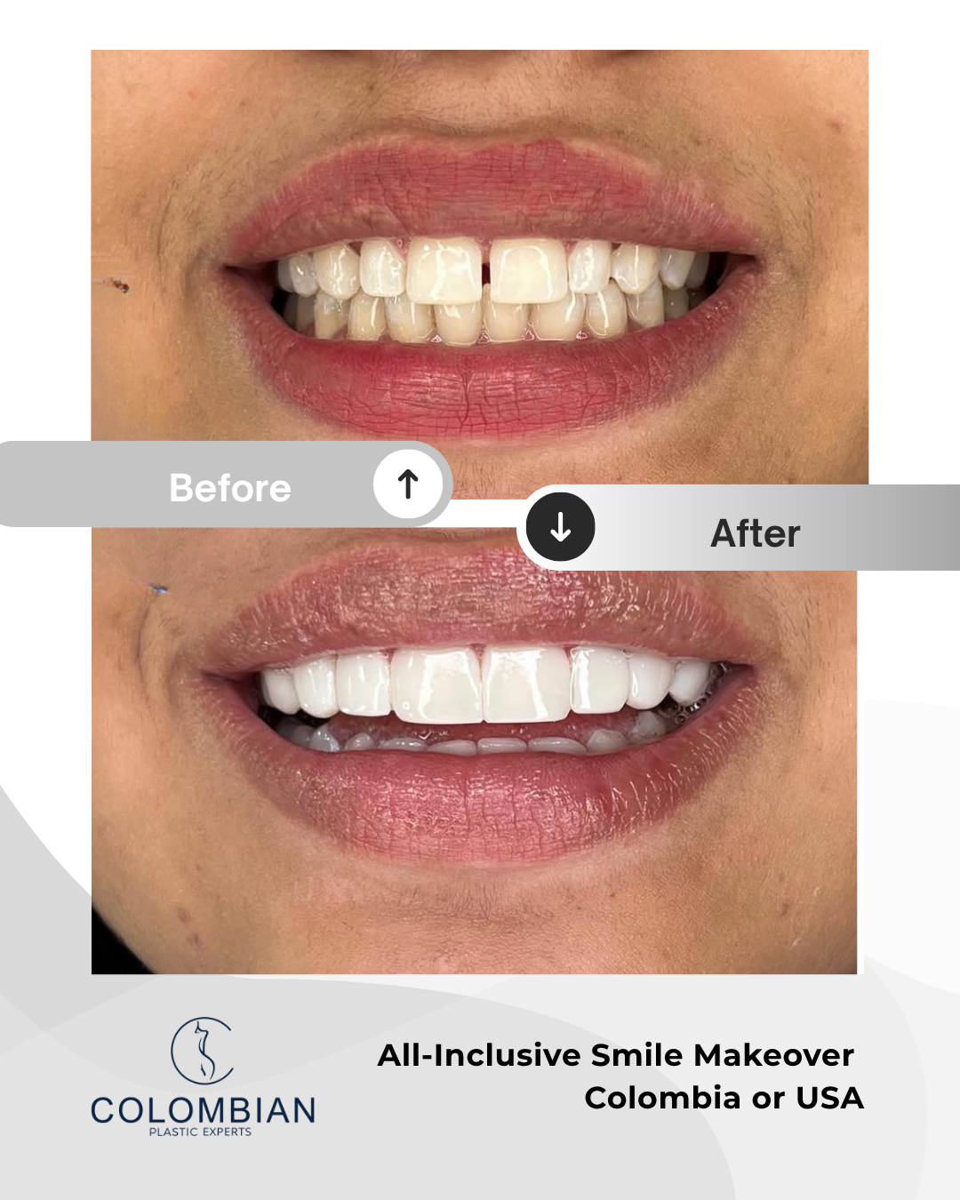 Full Payment – Smile Makeover Package (Cartagena, Colombia)