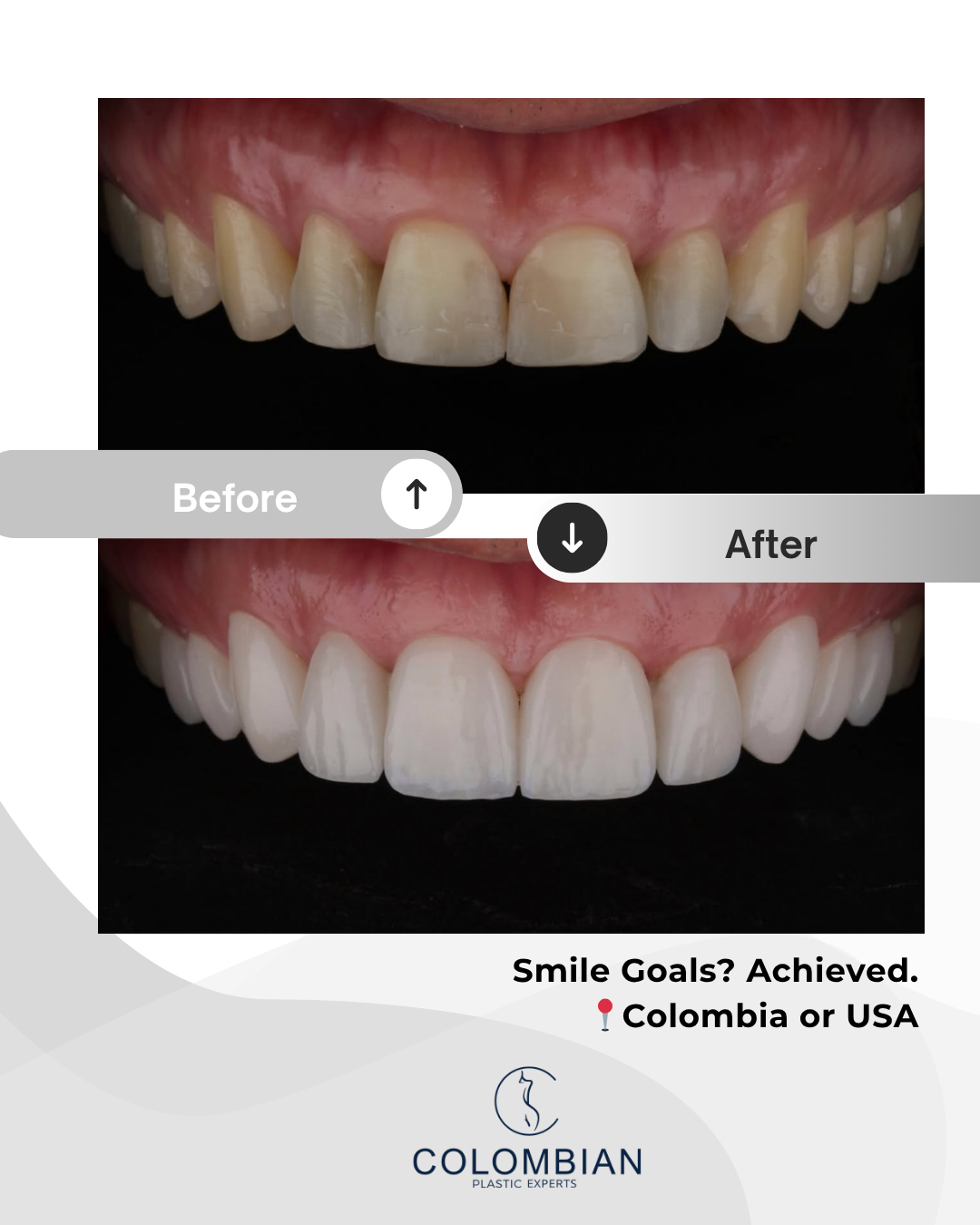 Full Payment – Smile Makeover Package (Cartagena, Colombia)