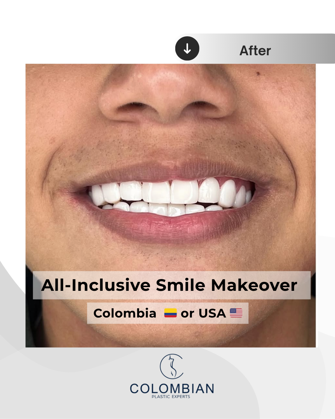 Full Payment – Smile Makeover Package (Cartagena, Colombia)
