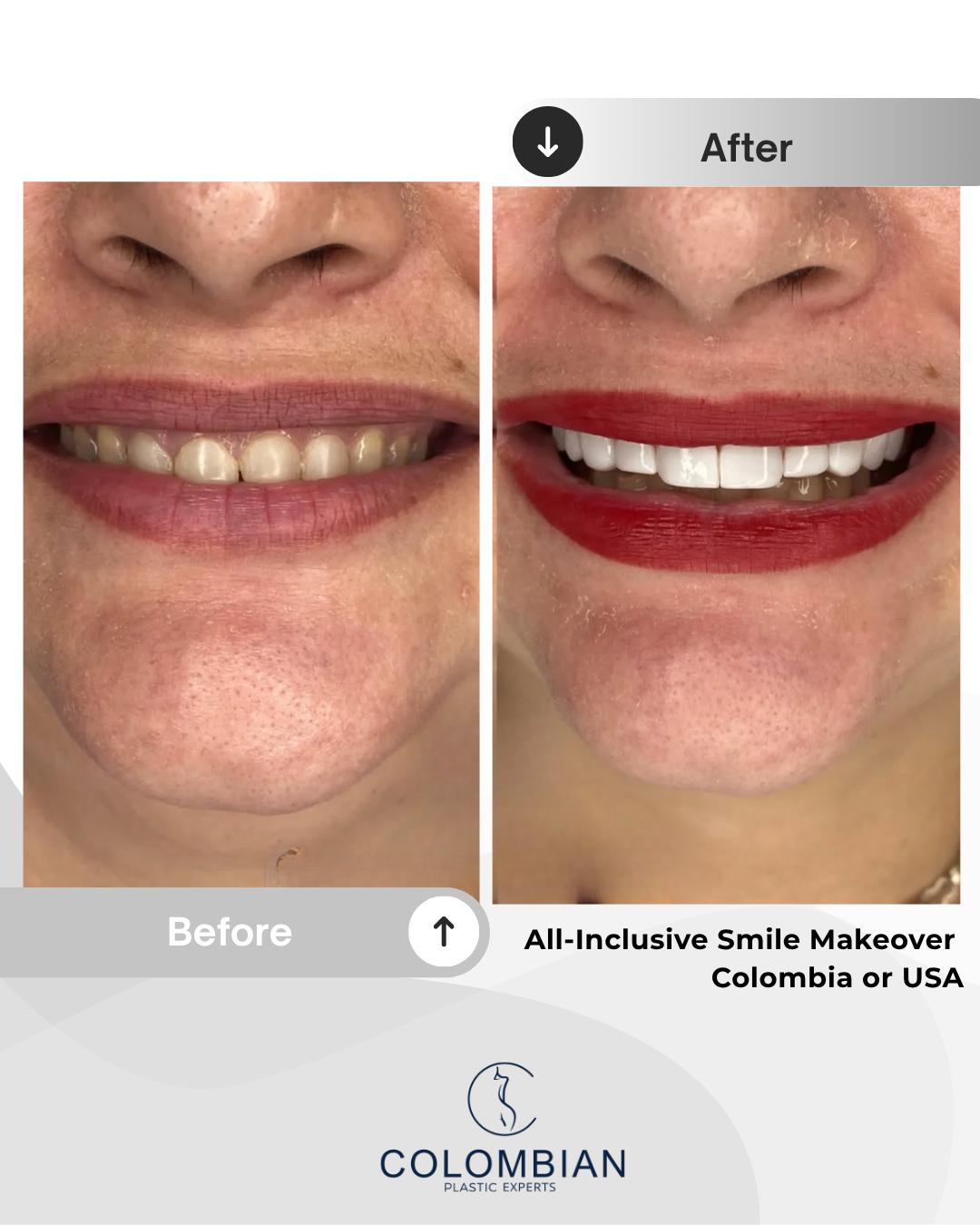 Full Payment – Smile Makeover Package (Cartagena, Colombia)