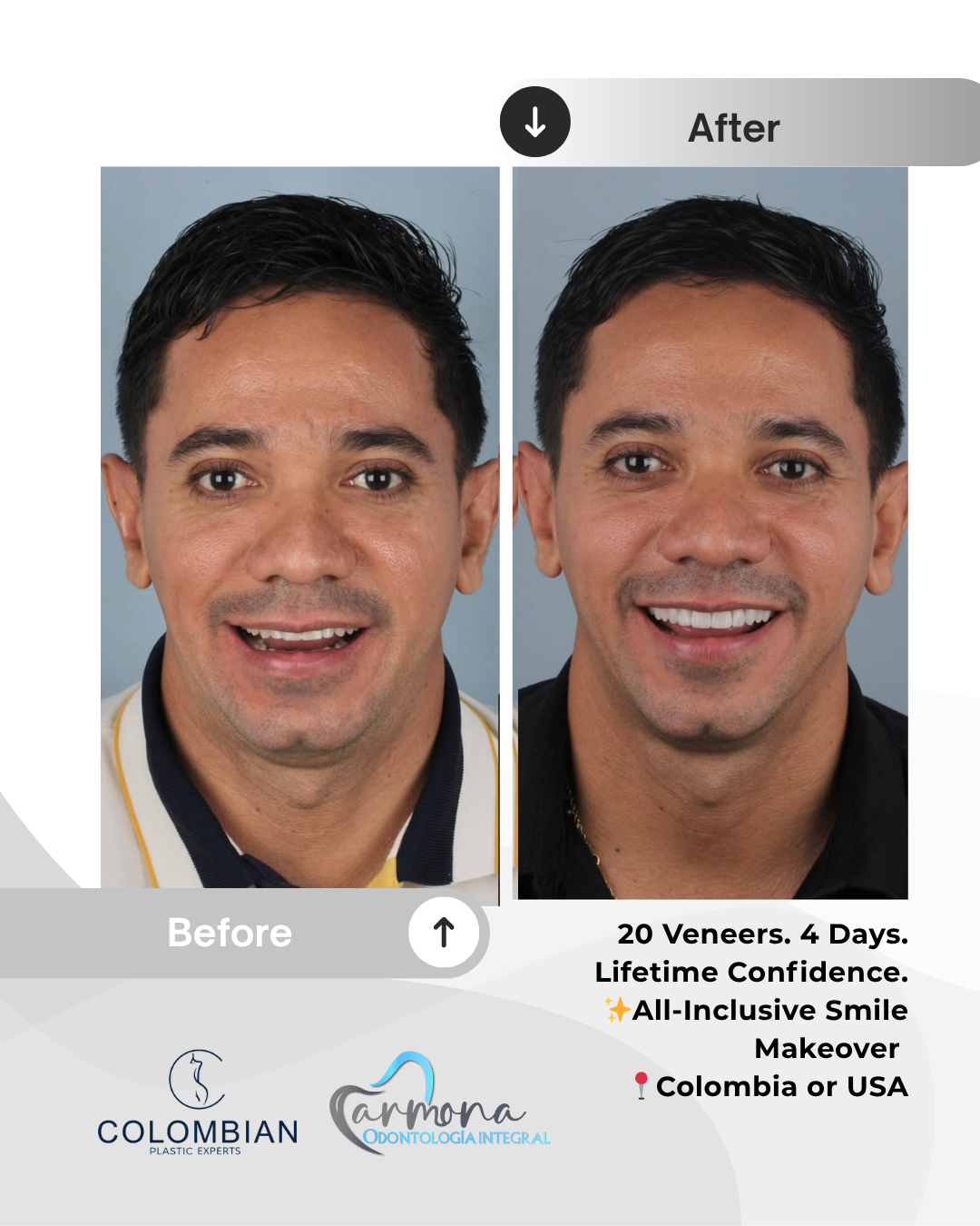 Full Payment – Smile Makeover Package (Cartagena, Colombia)