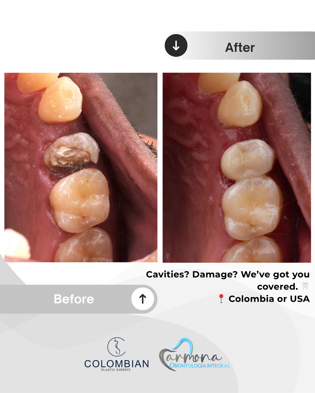Full Payment – Smile Makeover Package (Cartagena, Colombia)