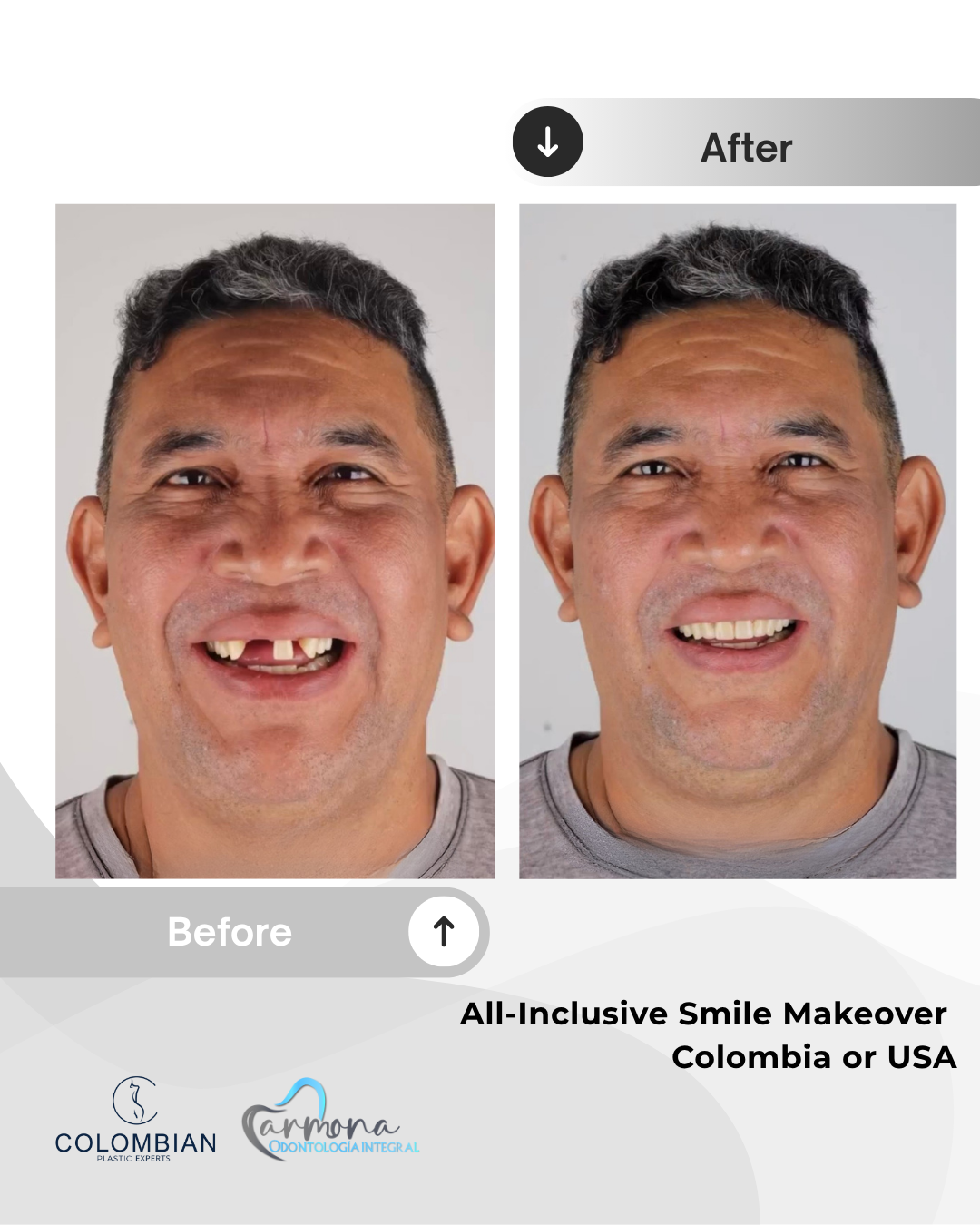 Full Payment – Smile Makeover Package (Cartagena, Colombia)