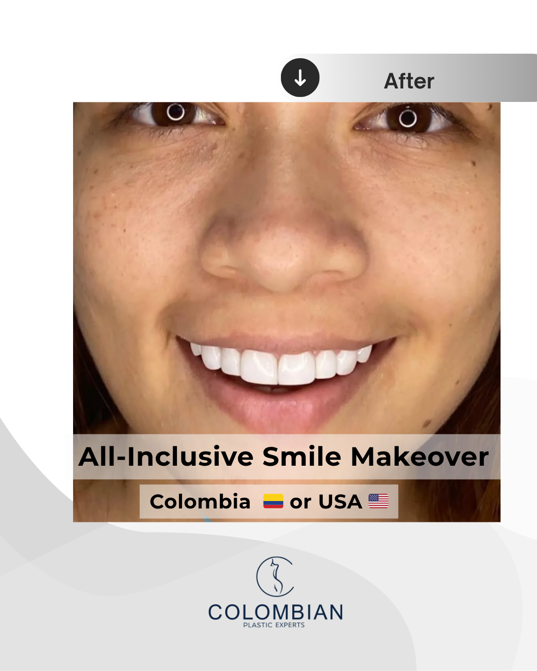 Full Payment – Smile Makeover Package (Cartagena, Colombia)