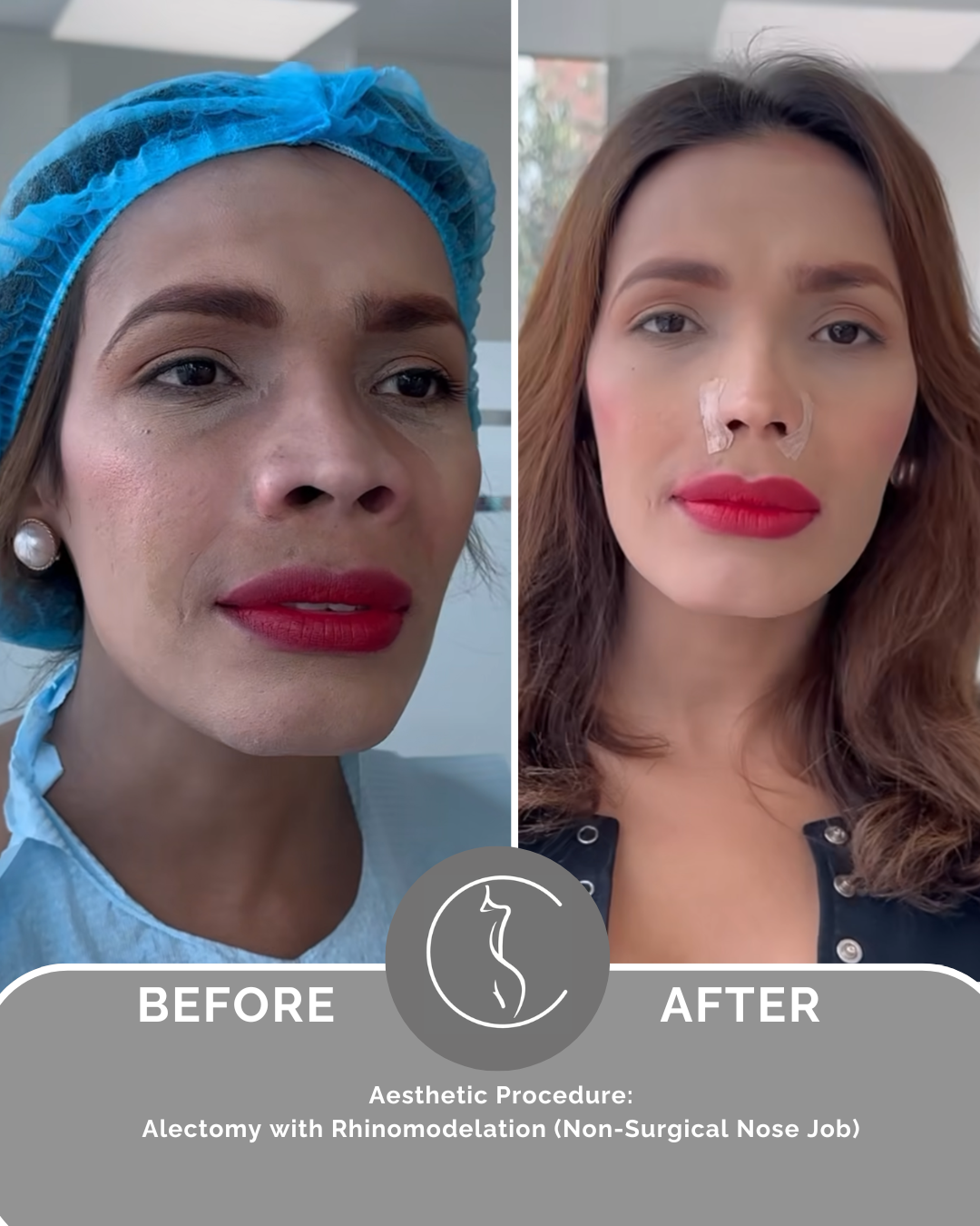 Alectomy Procedure – Full payment (Miami Event)