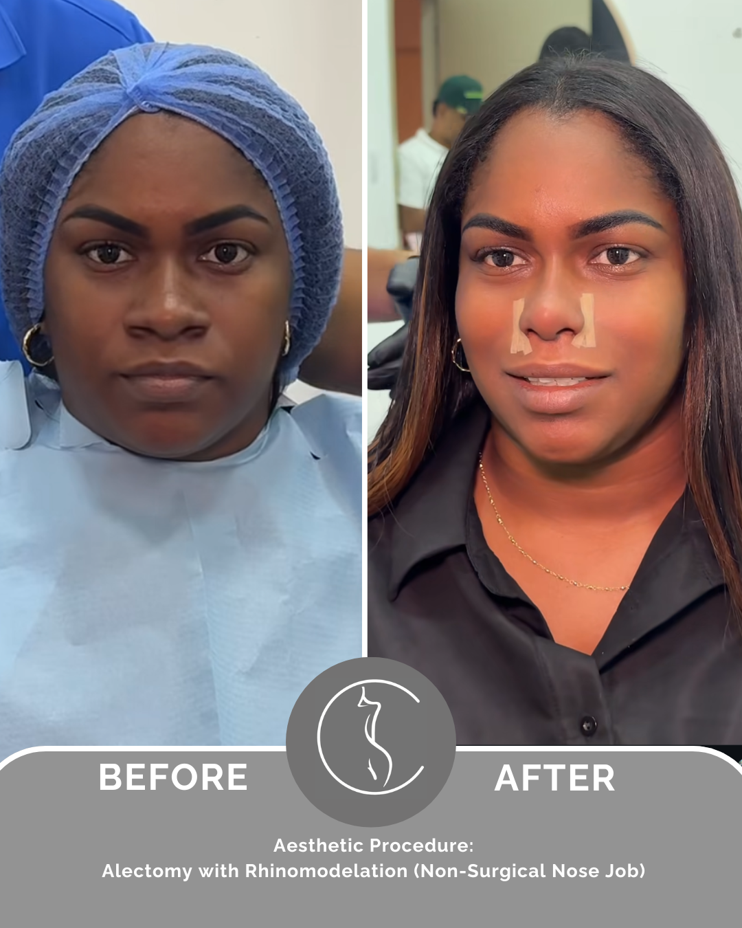 Alectomy Procedure – Full Payment (Miami - October Event)