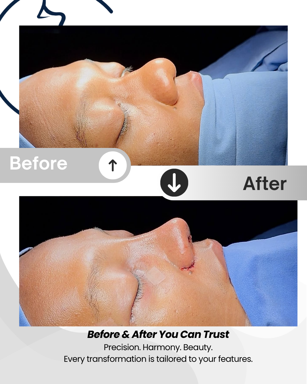 Ethnic Rhinoplasty – Full Package Medellín