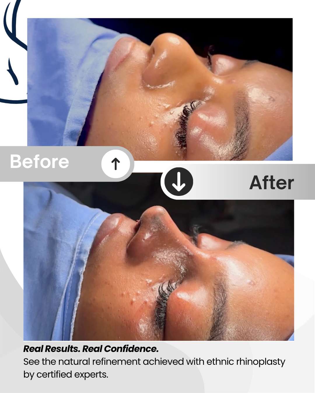 Ethnic Rhinoplasty – Full Package Medellín