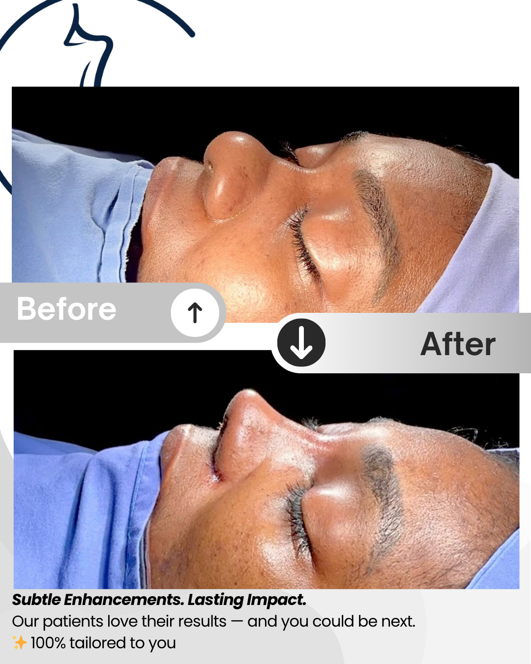 Ethnic Rhinoplasty – Full Package Medellín